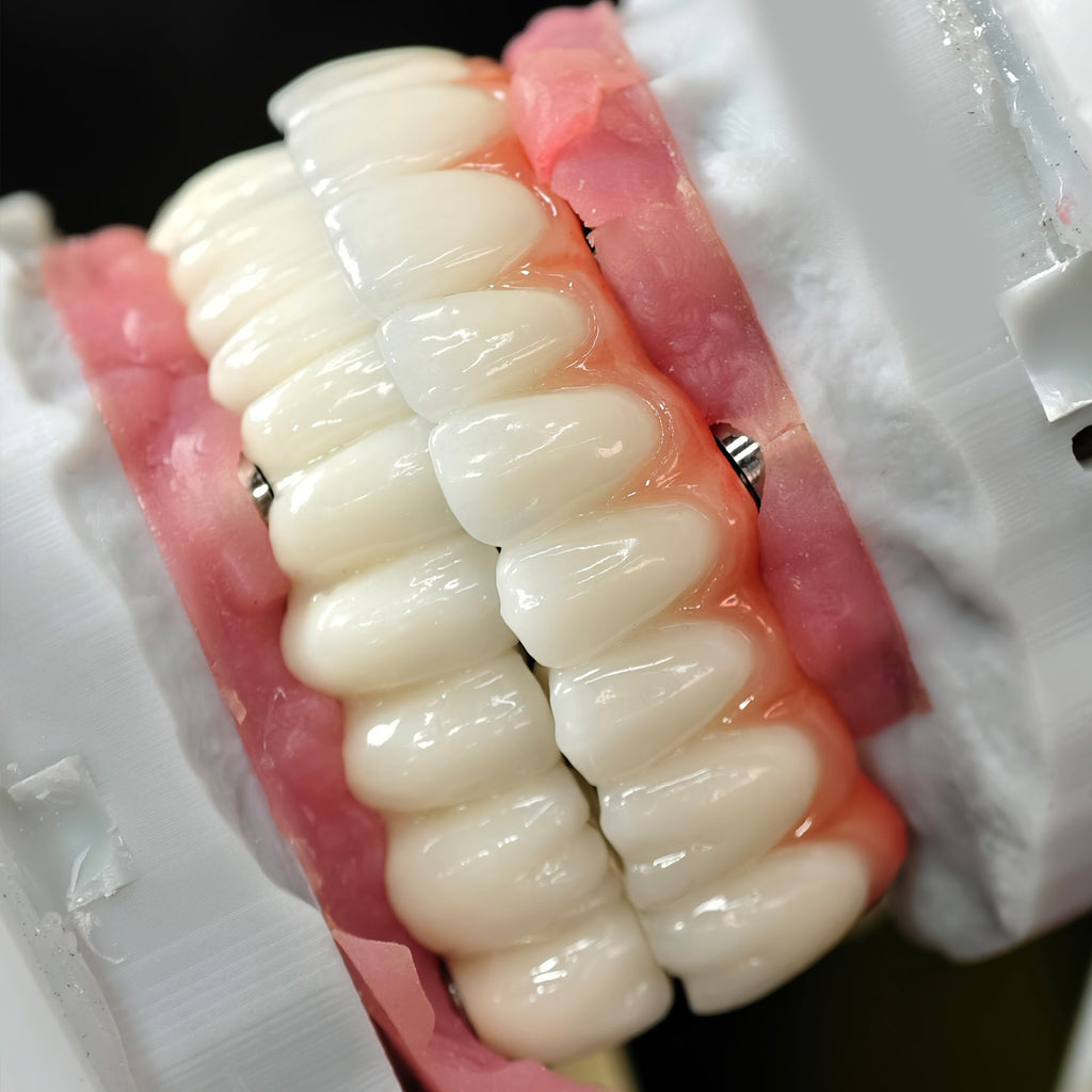 Implant-supported Co - Cr PFM Dental Bridge