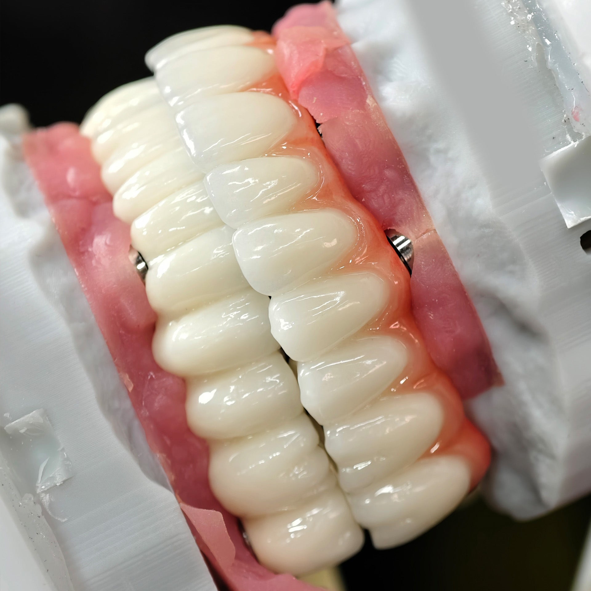 Implant-supported Co - Cr PFM Dental Bridge