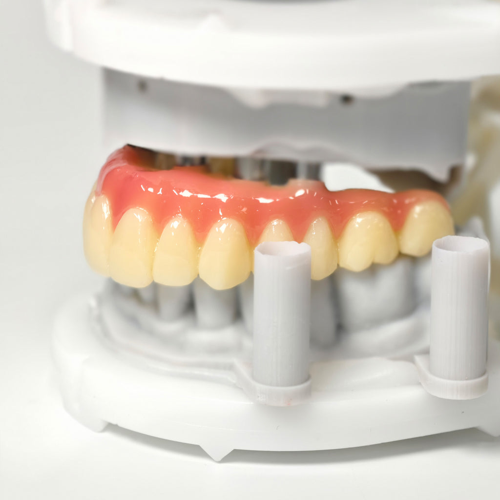 PMMA Bridge With Screw Retained