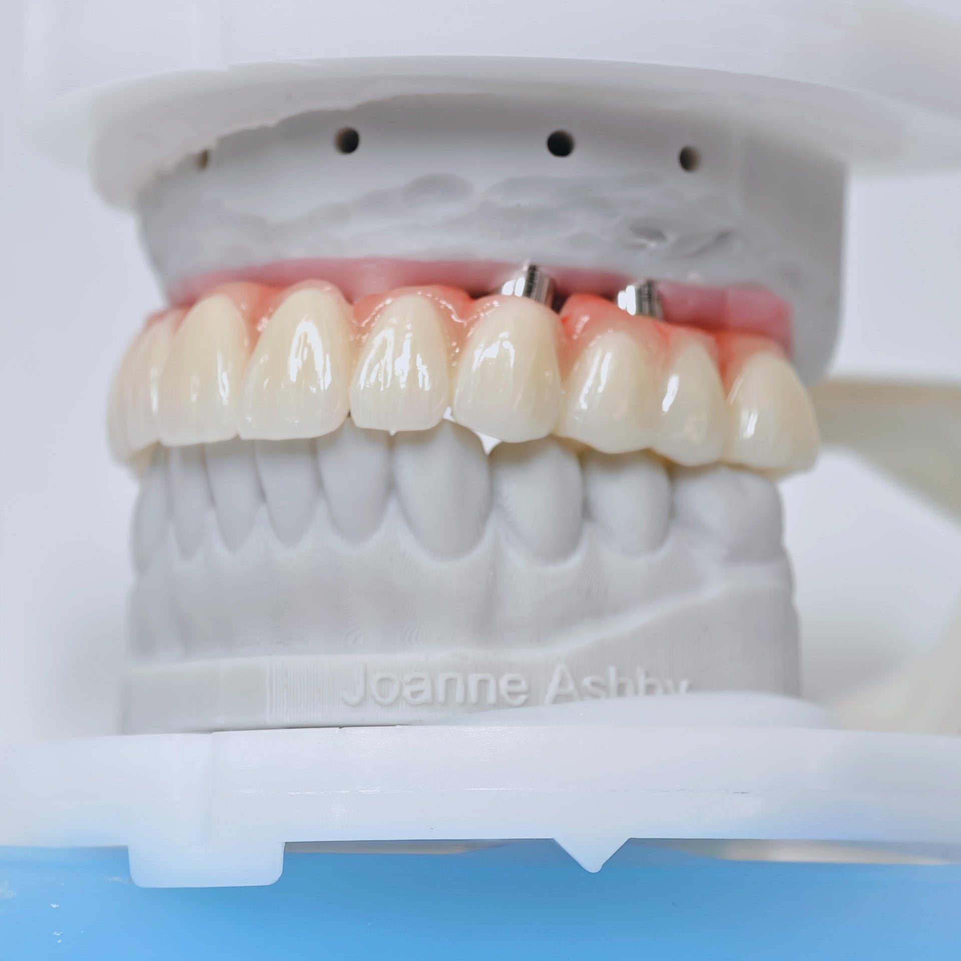 Ti-Bar Titanium Nitride Metal Frame With Zirconia Bridge For Full Arch Restoration