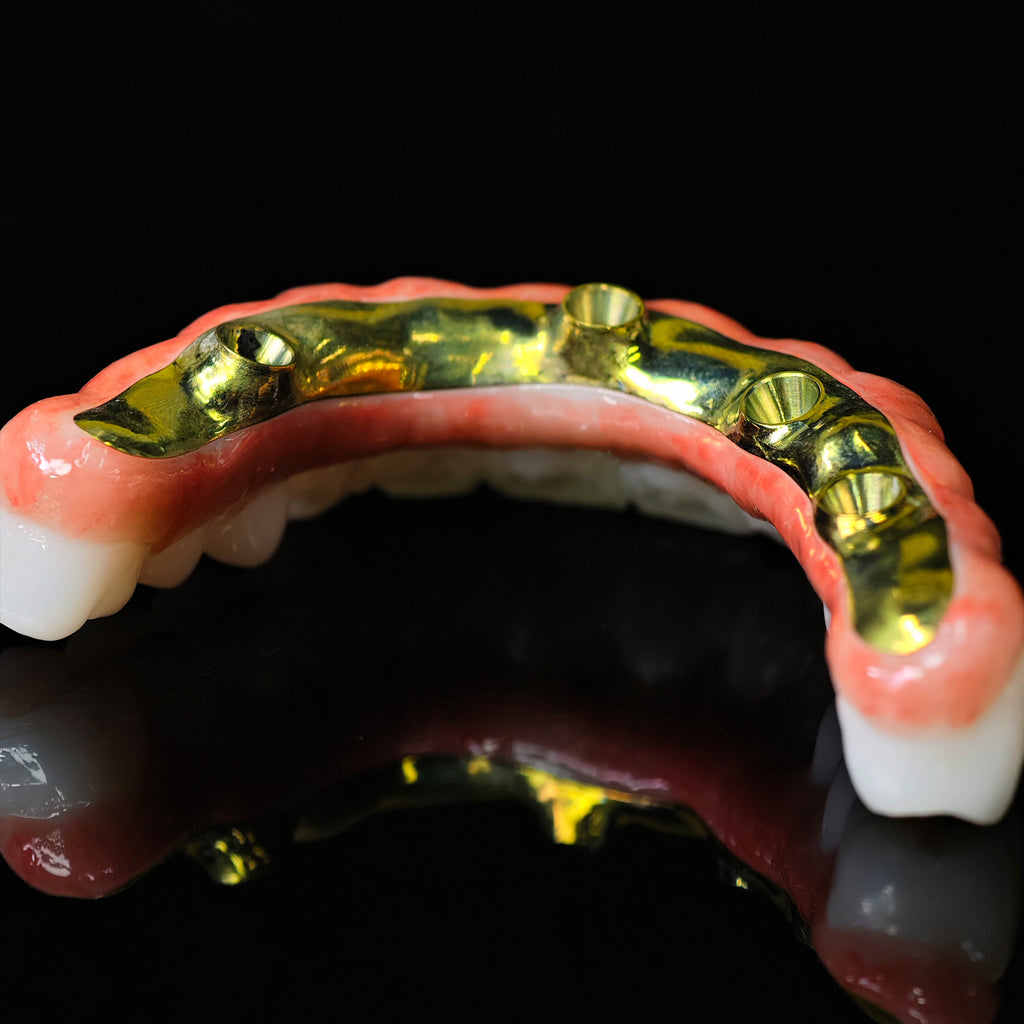 Ti-Bar Titanium Nitride Metal Frame With Zirconia Bridge For Full Arch Restoration