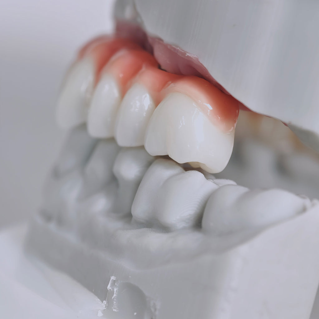 Zirconia-Enamel Hybrid Malo Bridge Aesthetic