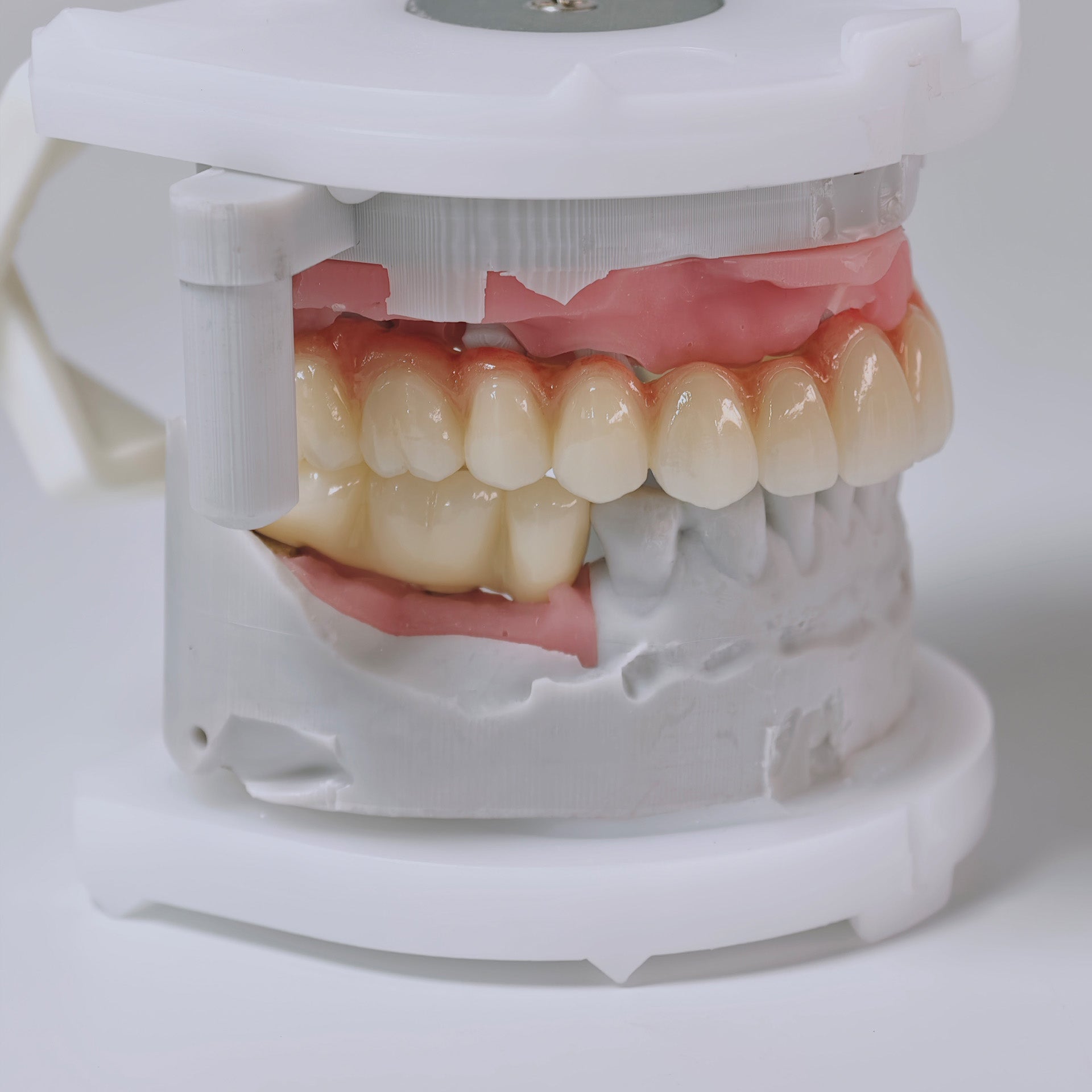 Zirconia Implant Bridges Screwmentable Dental Crown
