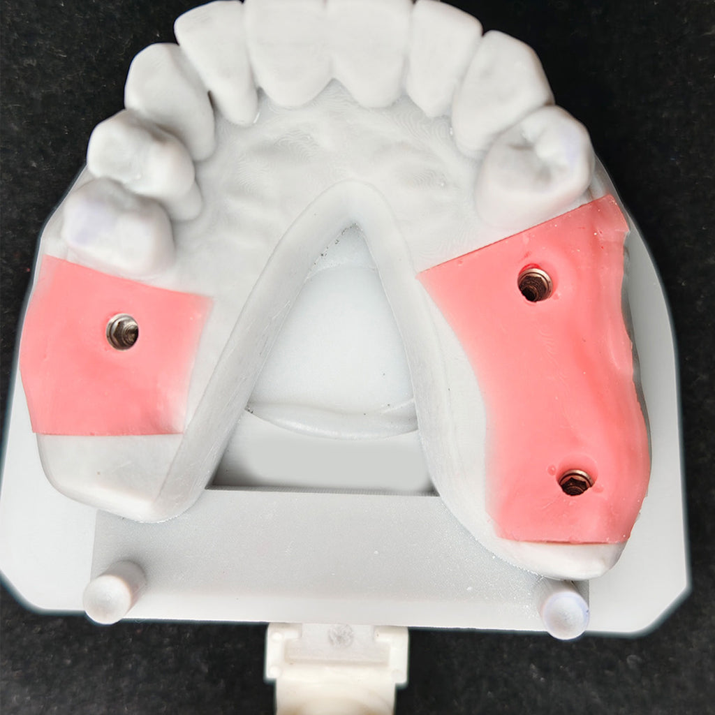 Custom Zirconia Implant Crown And Bridge