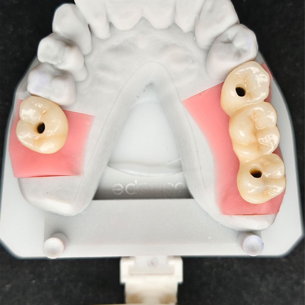 Custom Zirconia Implant Crown And Bridge