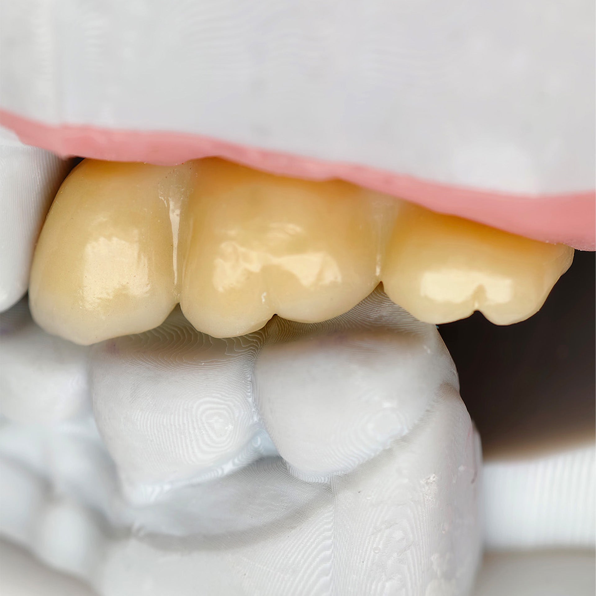 Custom Zirconia Implant Crown And Bridge