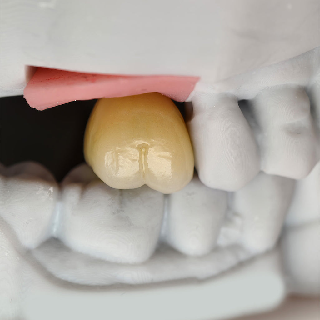 Custom Zirconia Implant Crown And Bridge