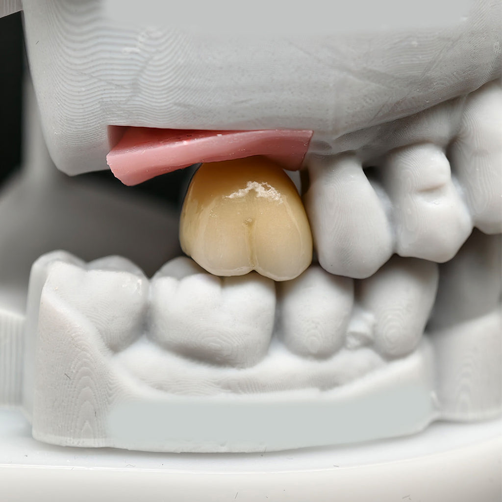 Custom Zirconia Implant Crown And Bridge