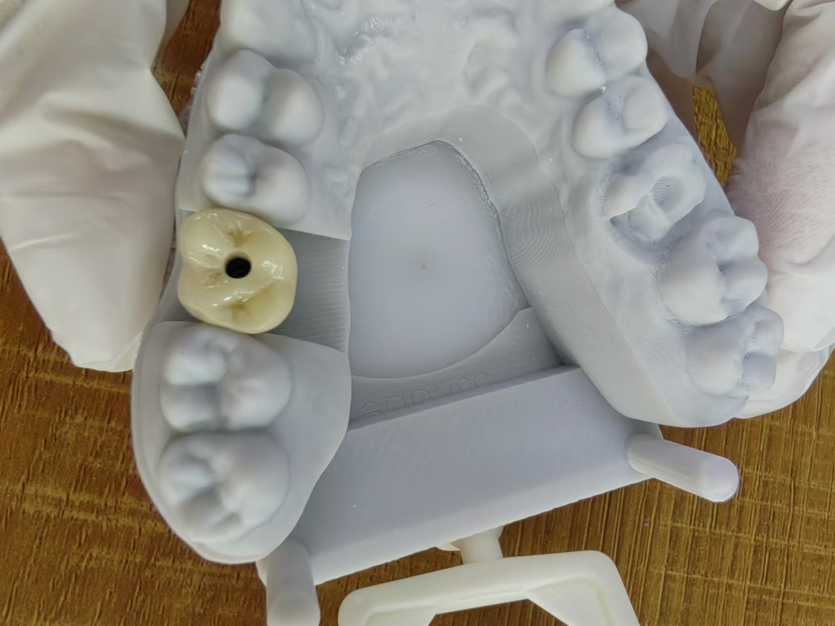 Zirconia Implant Crown Screw Retained Zirconia Dental Crown