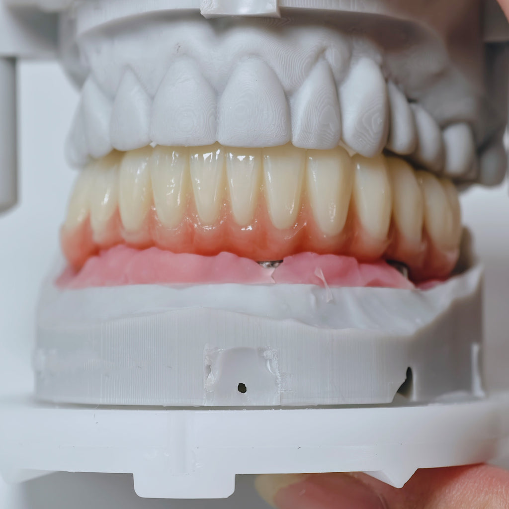 All On 4 Zirconia Bridge With Ti-Base Screw Retained