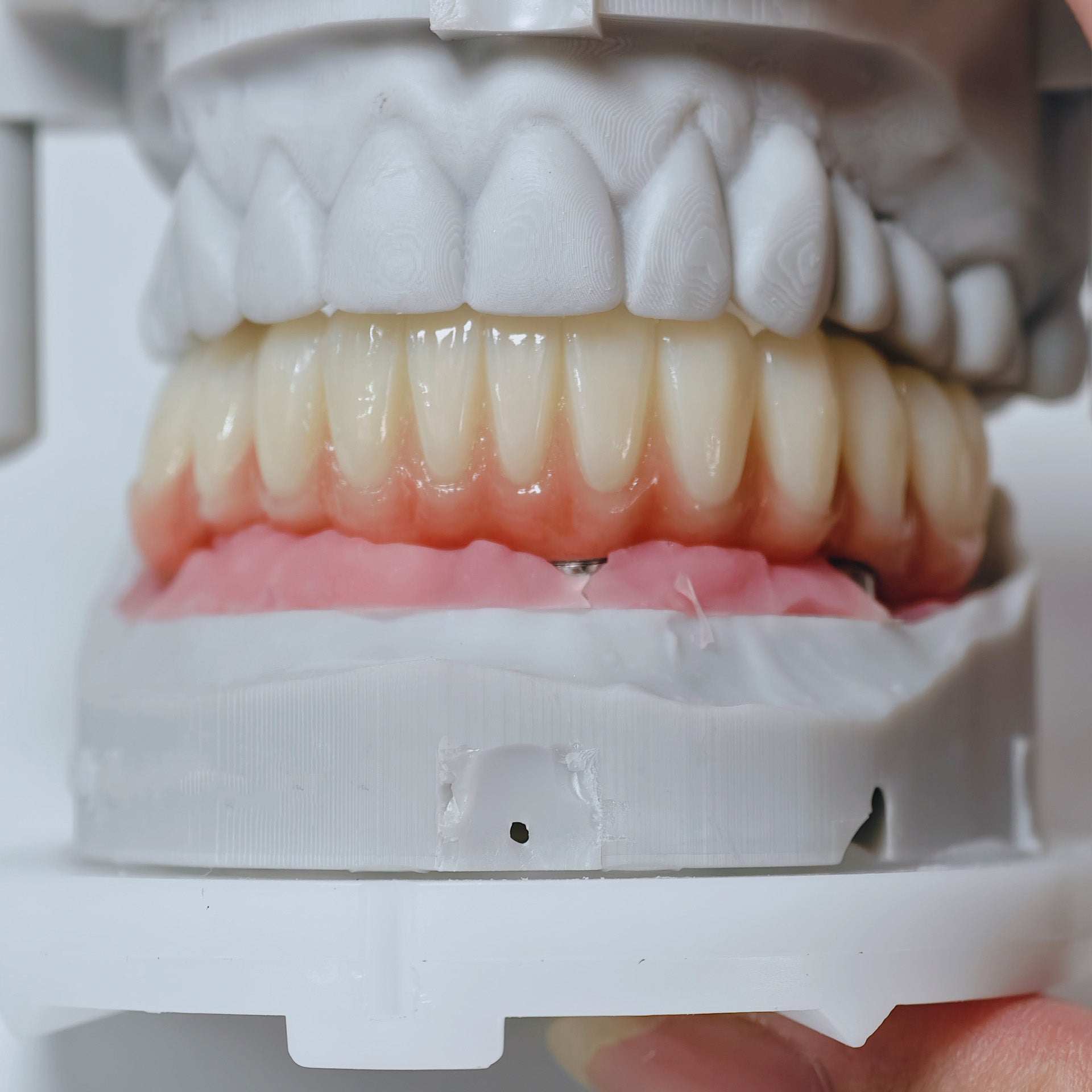 All On 4 Zirconia Bridge With Ti-Base Screw Retained