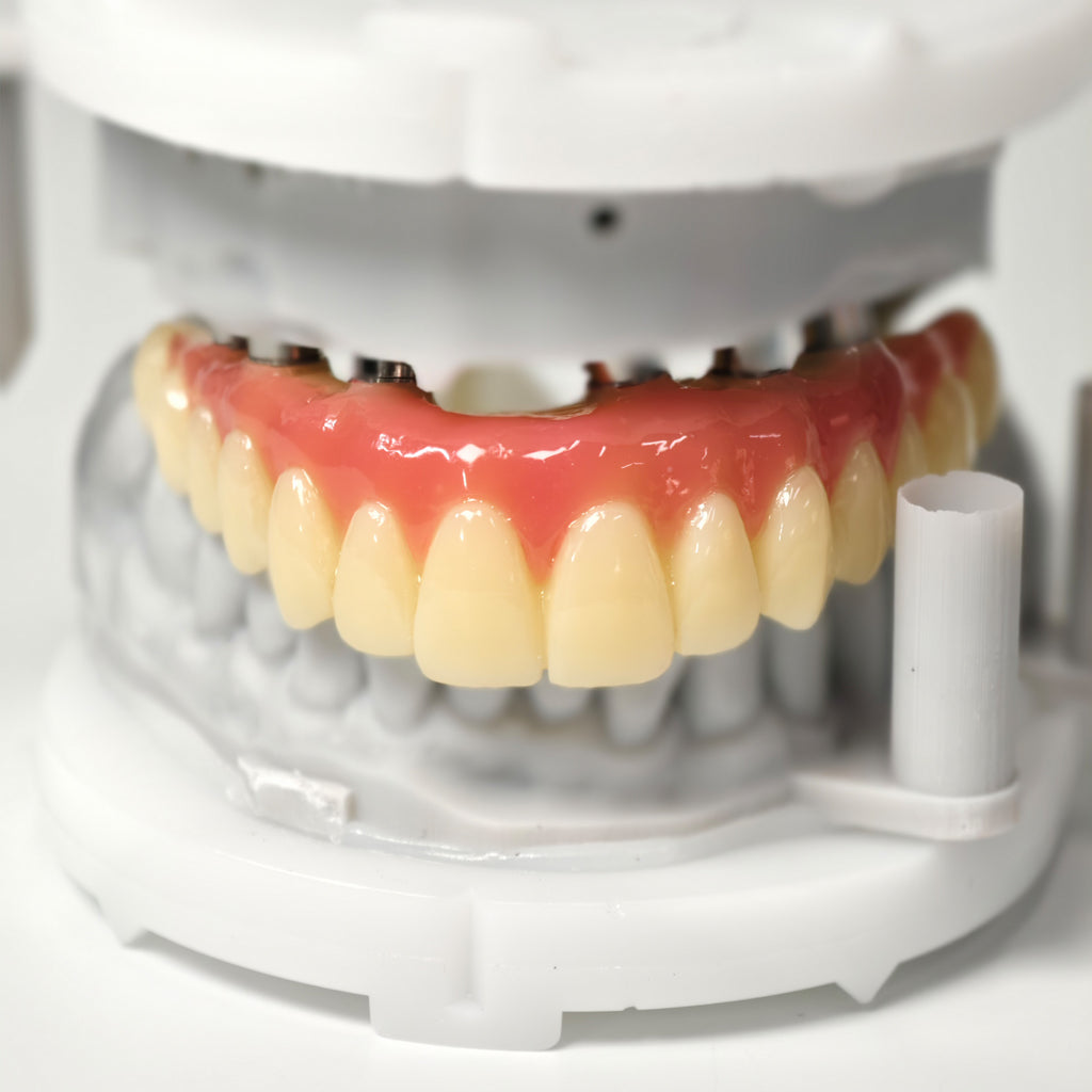 PMMA Bridge With Screw Retained