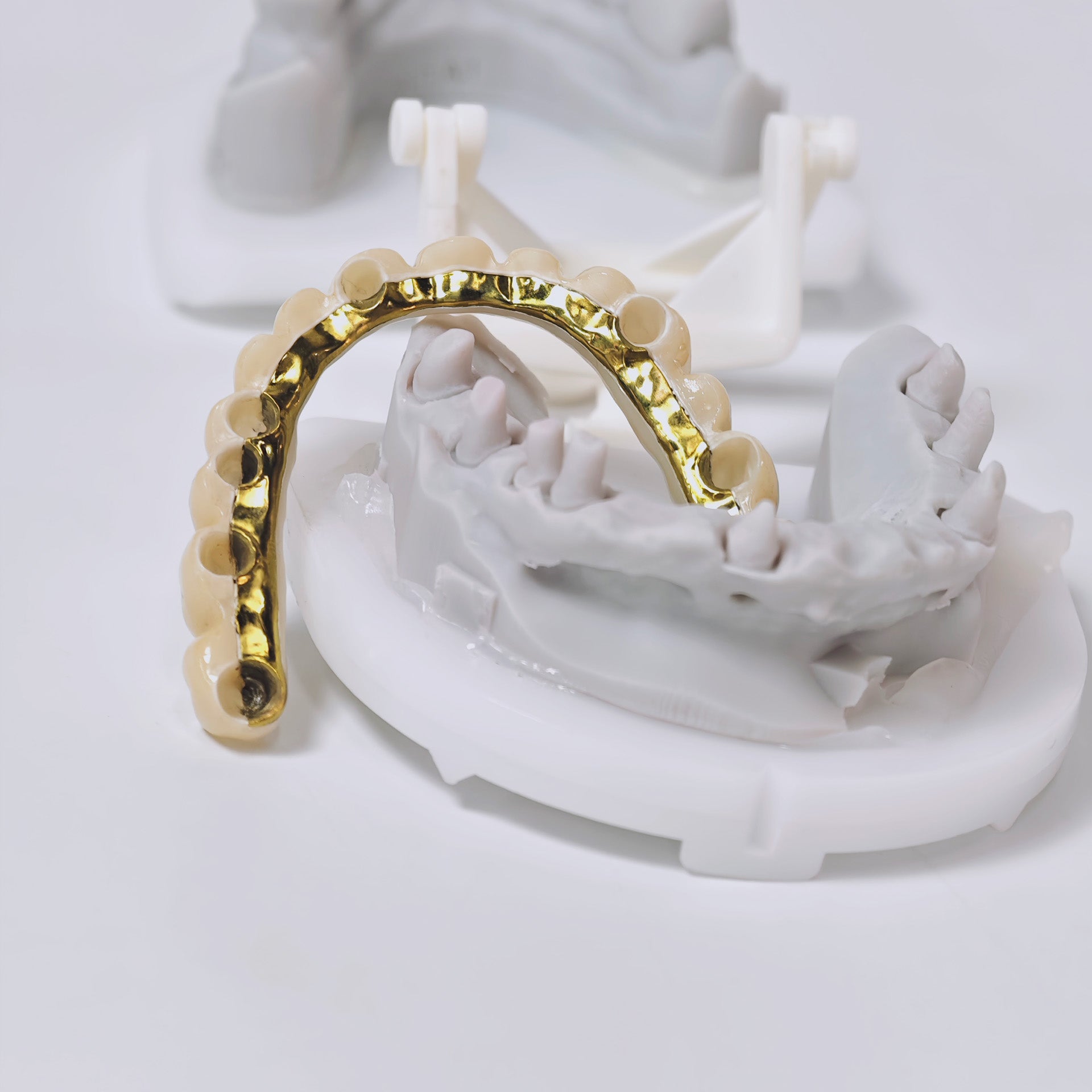 Ti-Bar Titanium Nitride Metal Frame With Zirconia Bridge And Cement Retained