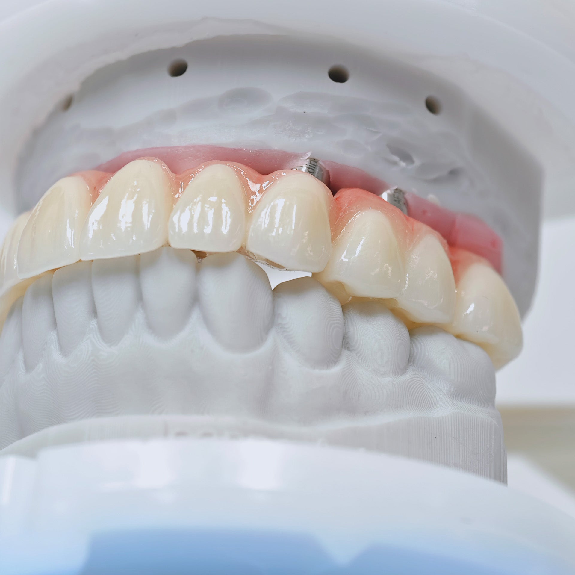 Ti-Bar Titanium Nitride Metal Frame With Zirconia Bridge For Full Arch Restoration