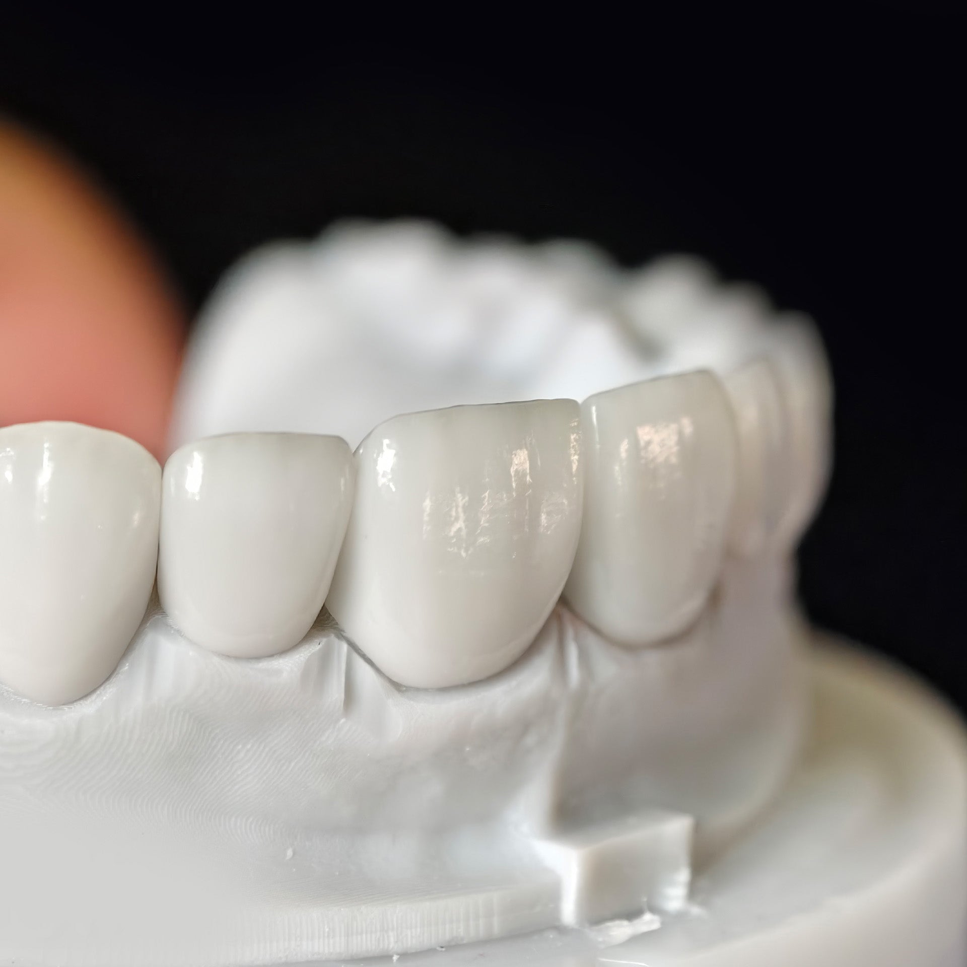 Ultra-Thin Emax Veneer. High Transparency/Translucent, Natural Shade