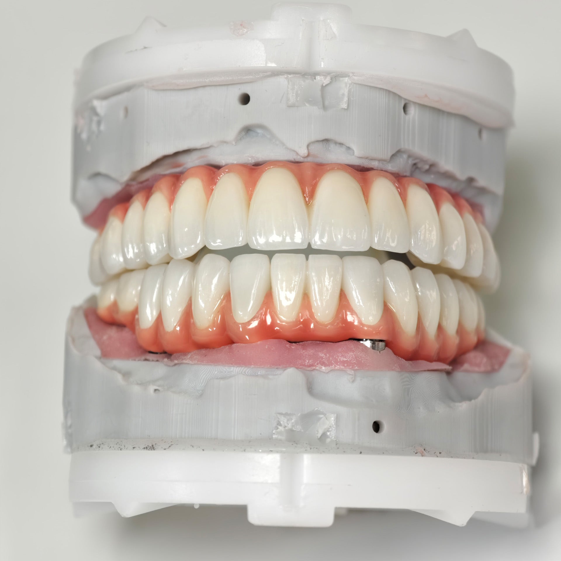 Zirconia-Enamel Hybrid Malo Bridge