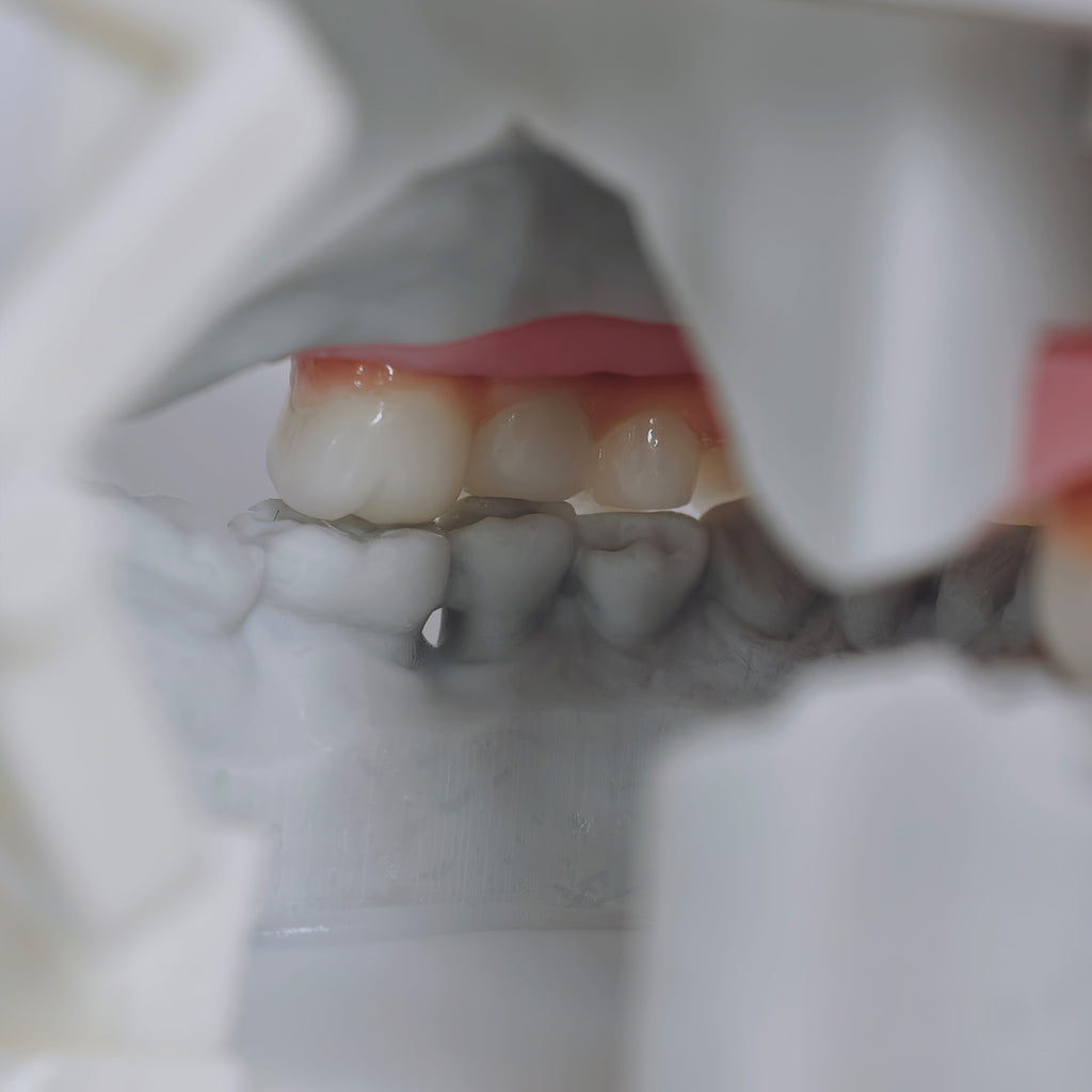 Zirconia-Enamel Hybrid Malo Bridge Aesthetic