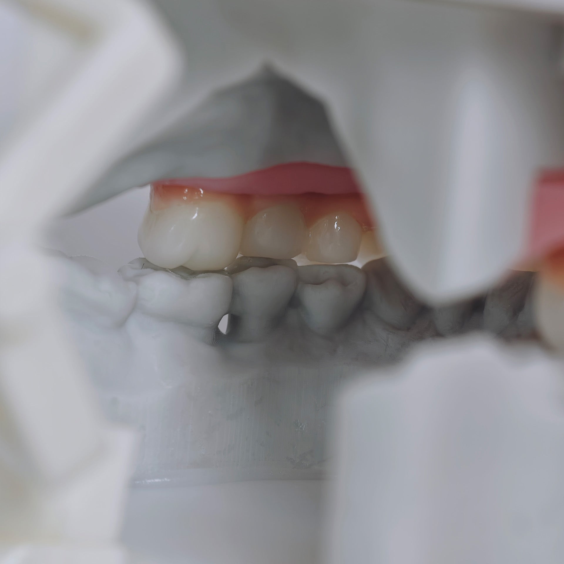 Zirconia-Enamel Hybrid Malo Bridge Aesthetic