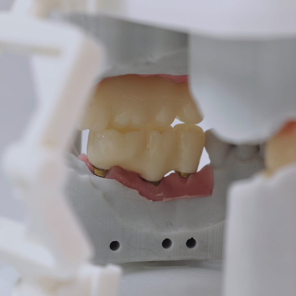 Zirconia Implant Bridges Screwmentable Dental Crown