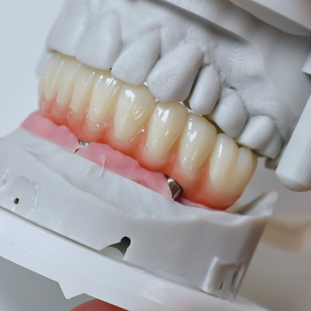 All On 4 Zirconia Bridge With Ti-Base Screw Retained
