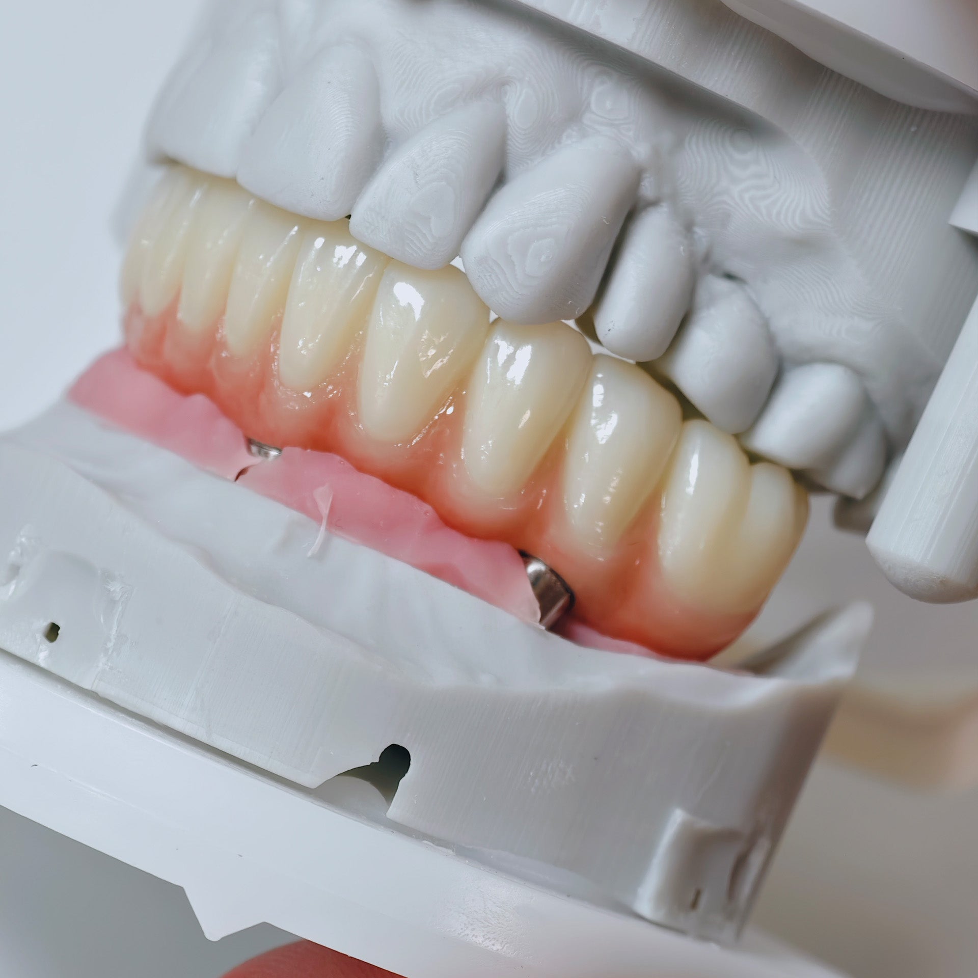 All On 4 Zirconia Bridge With Ti-Base Screw Retained