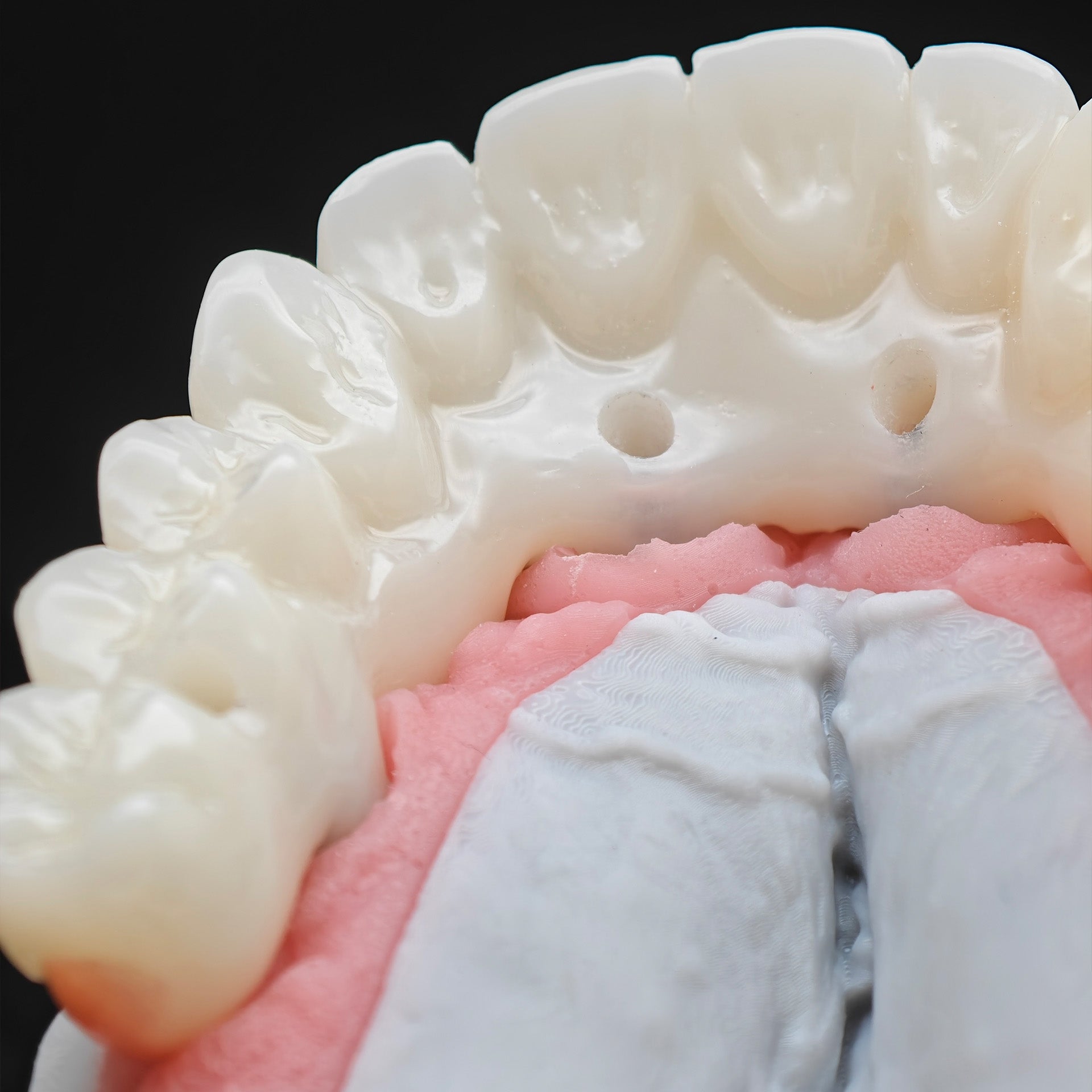 PMMA Bridge With Ti-Base Screw Retained Trying For Full Arch Restoration