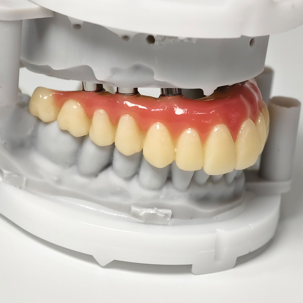 PMMA Bridge With Screw Retained