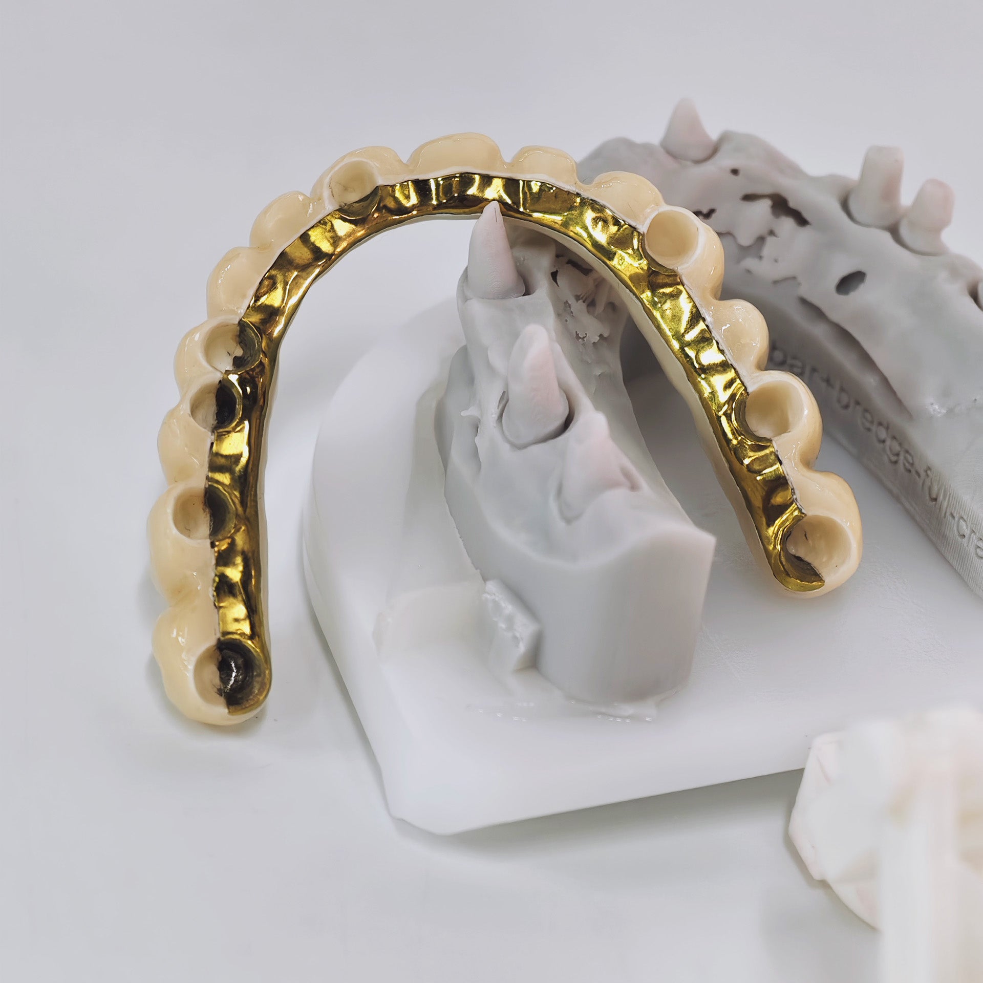 Ti-Bar Titanium Nitride Metal Frame With Zirconia Bridge And Cement Retained