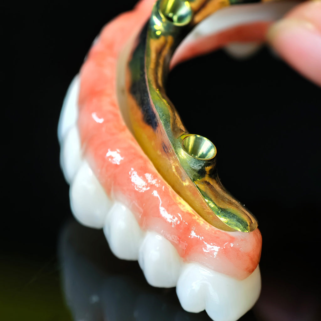Ti-Bar Titanium Nitride Metal Frame With Zirconia Bridge For Full Arch Restoration