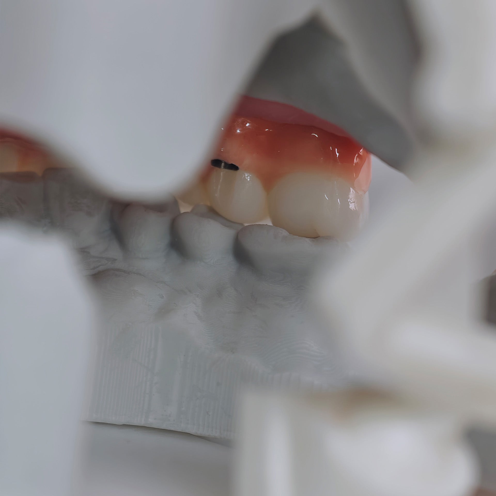 Zirconia-Enamel Hybrid Malo Bridge Aesthetic