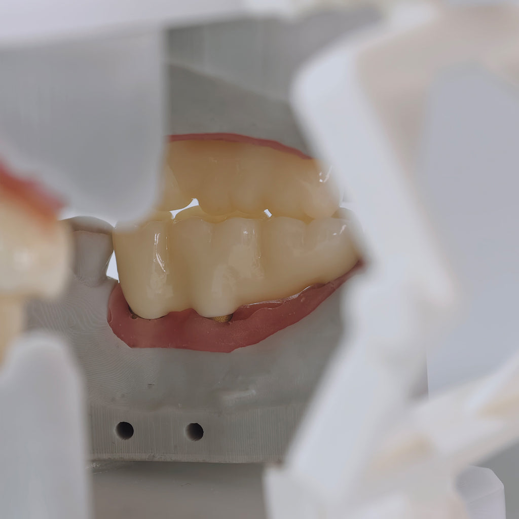 Zirconia Implant Bridges Screwmentable Dental Crown