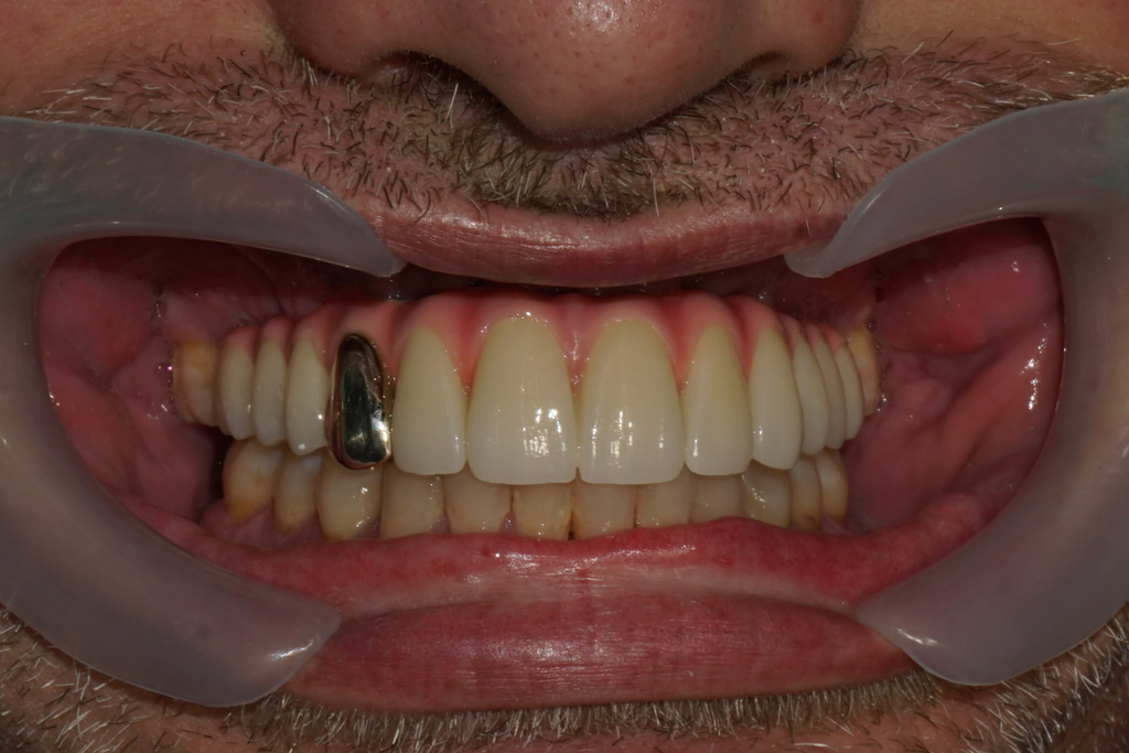 Malo Bridge With Gold-Plated Titanium Framework And A Gold Crown