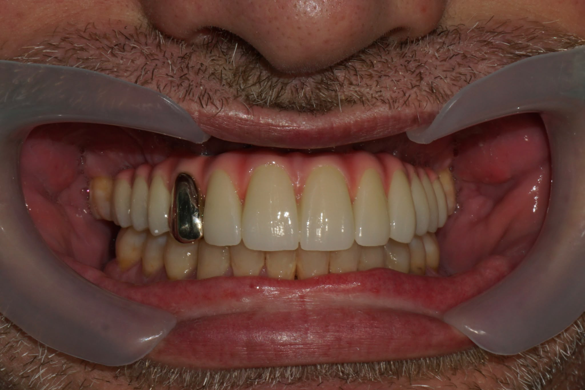 Malo Bridge With Gold-Plated Titanium Framework And A Gold Crown