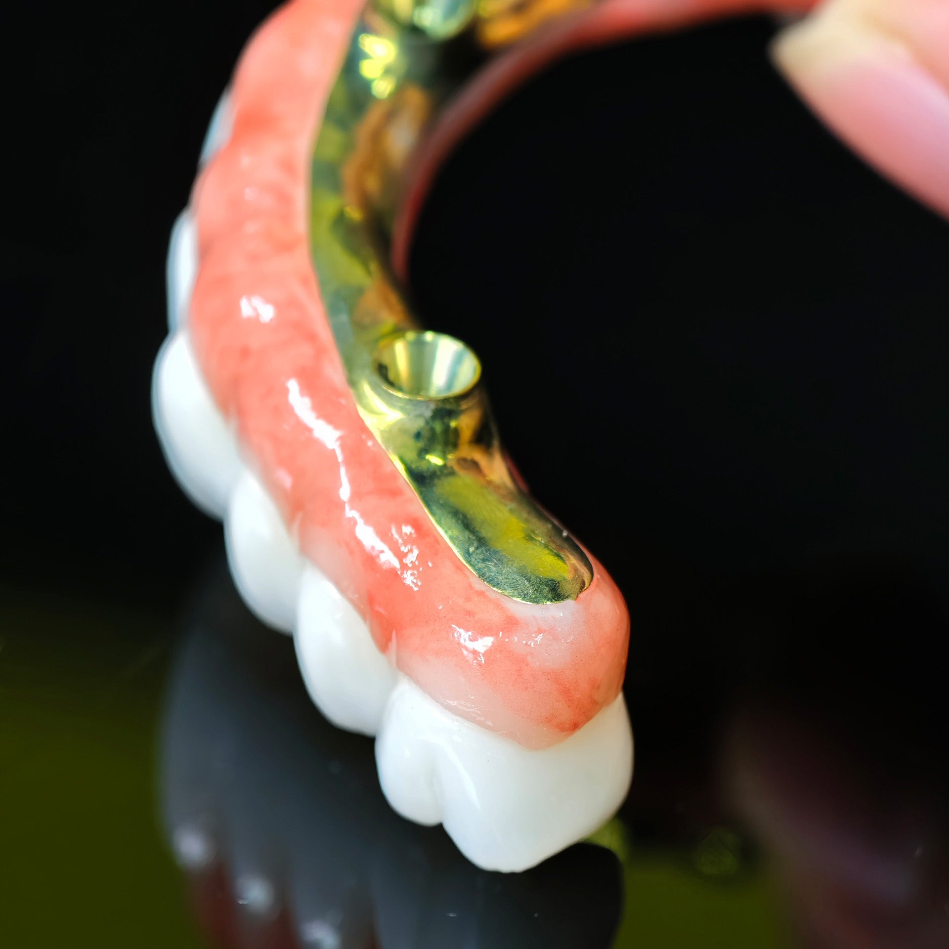 Ti-Bar Titanium Nitride Metal Frame With Zirconia Bridge For Full Arch Restoration