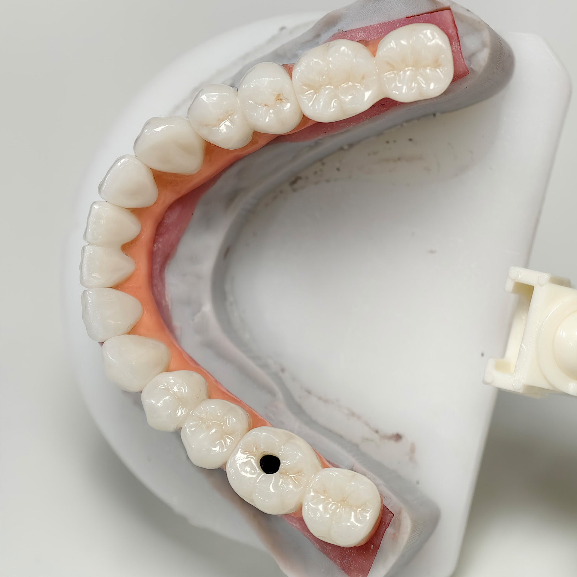 Zirconia-Enamel Hybrid Malo Bridge