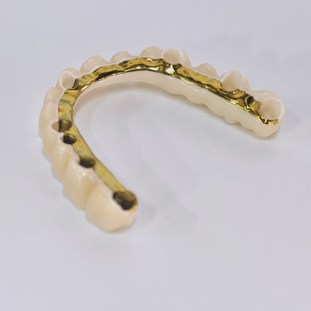 Ti-Bar Titanium Nitride Metal Frame With Zirconia Bridge And Cement Retained