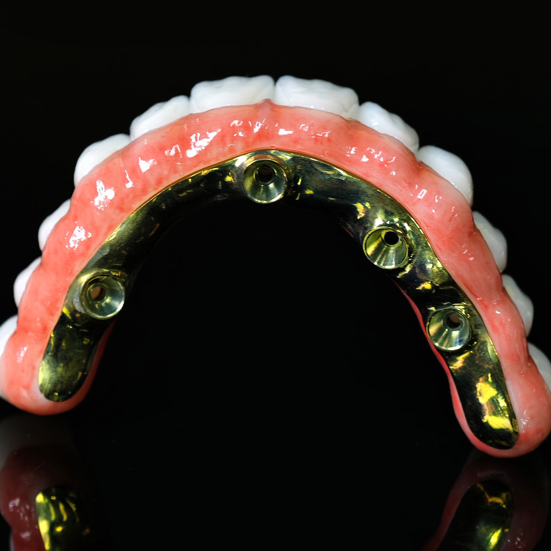 Ti-Bar Titanium Nitride Metal Frame With Zirconia Bridge For Full Arch Restoration