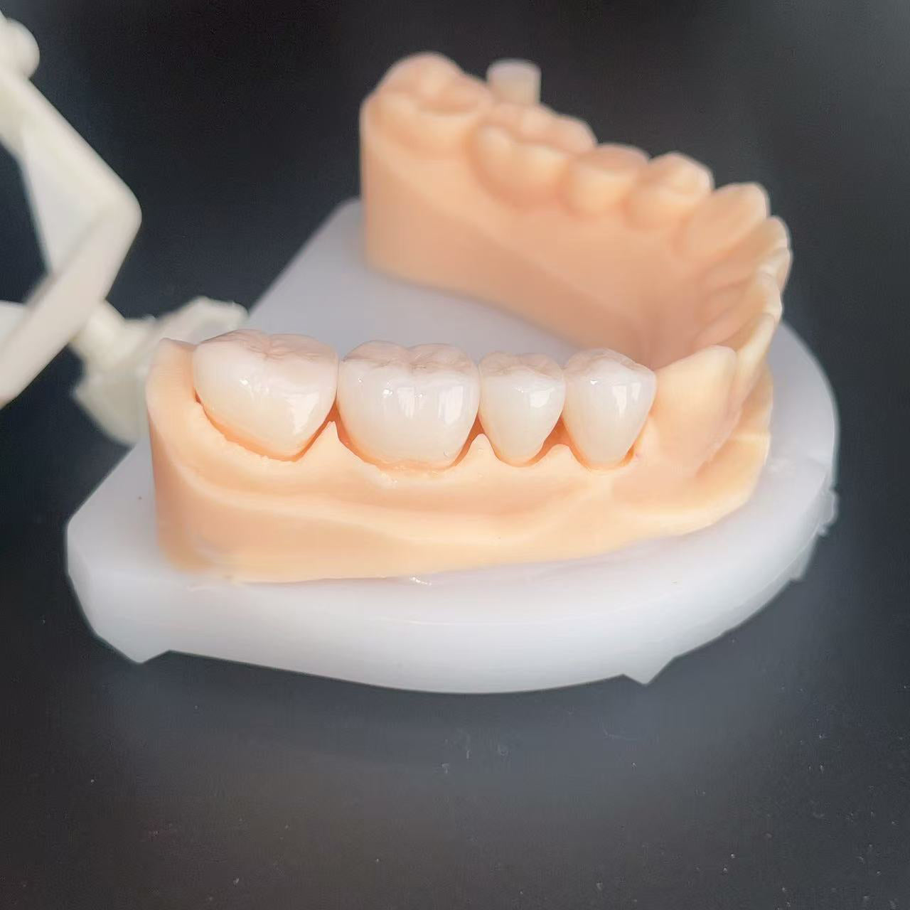 Individual Zirconia Crowns