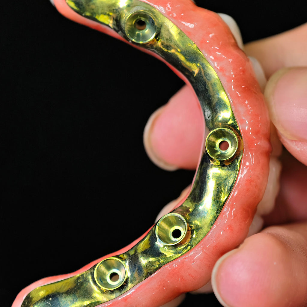 Ti-Bar Titanium Nitride Metal Frame With Zirconia Bridge For Full Arch Restoration