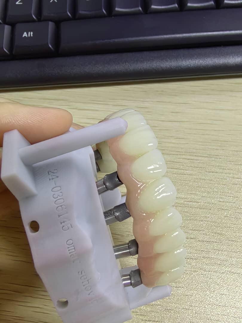 All On 6 Cement Retained PFZ Bridge With Titanium Custom Abutment