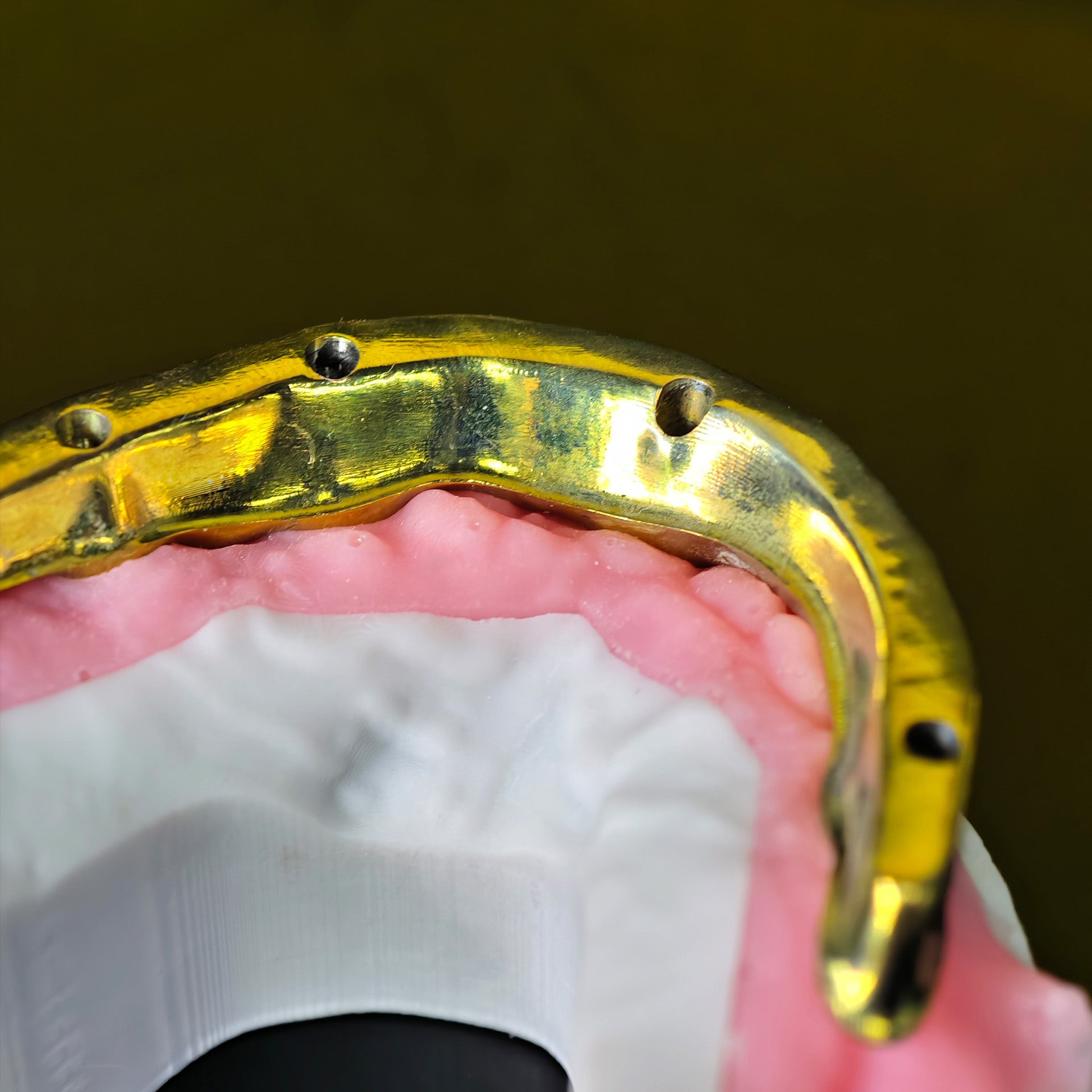 Ti-Bar Titanium Nitride Metal Frame With Zirconia Bridge For Full Arch Restoration