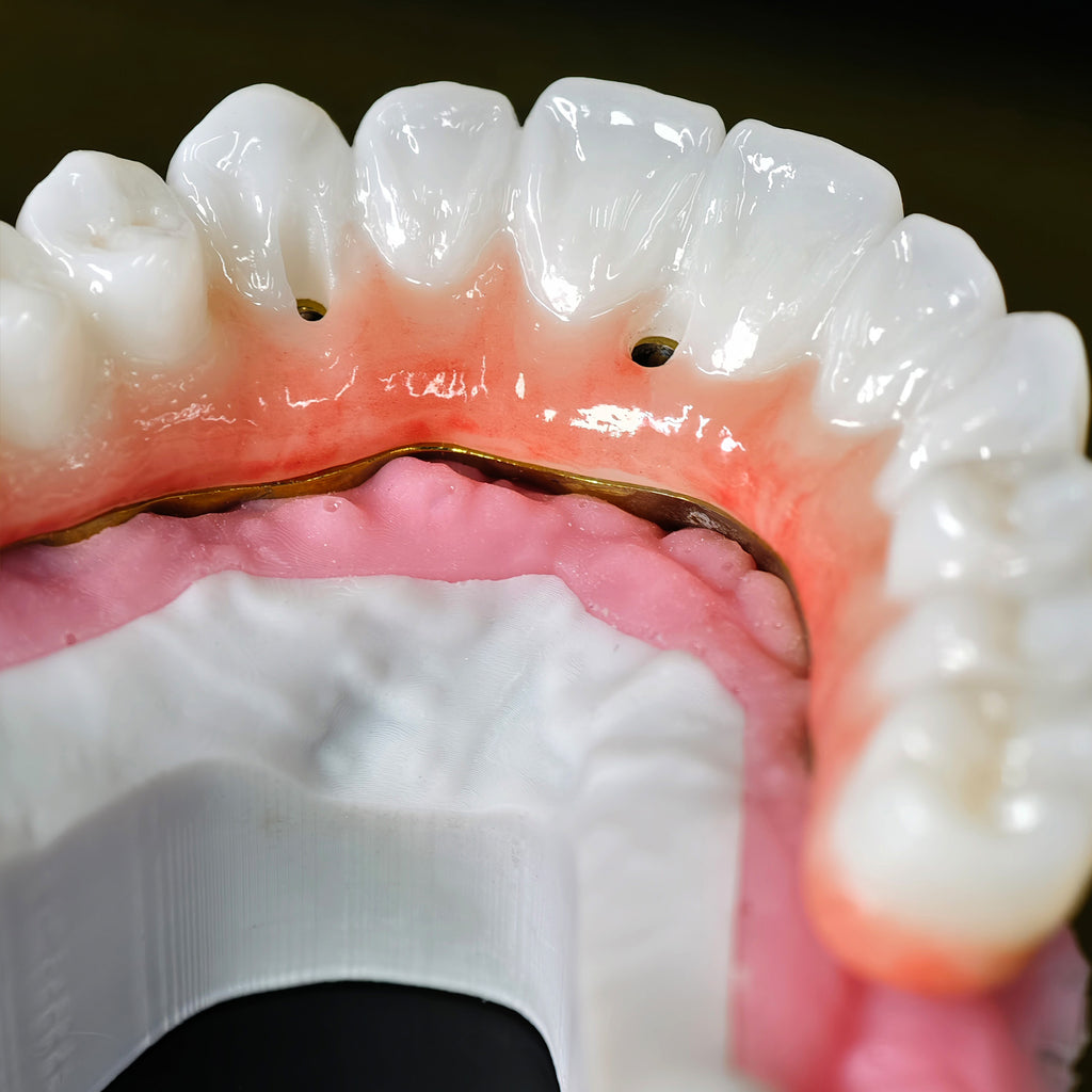 Ti-Bar Titanium Nitride Metal Frame With Zirconia Bridge For Full Arch Restoration