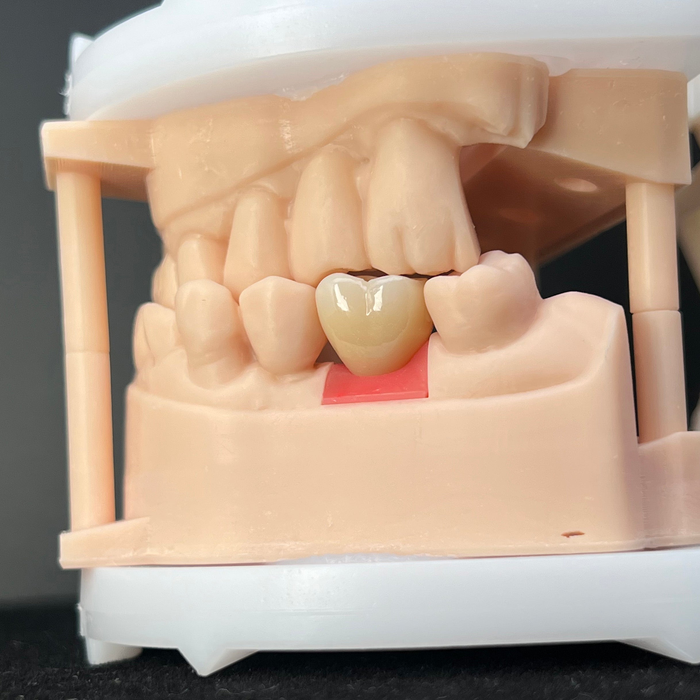 Precision Zirconia Implant Crown