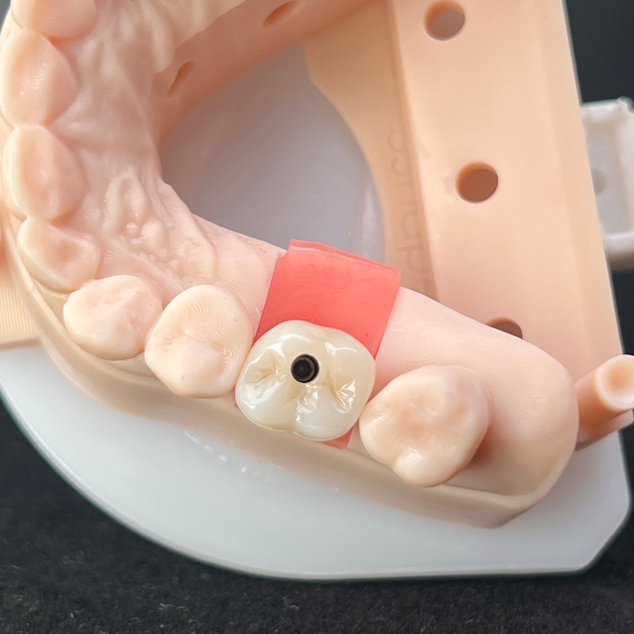 Precision Zirconia Implant Crown