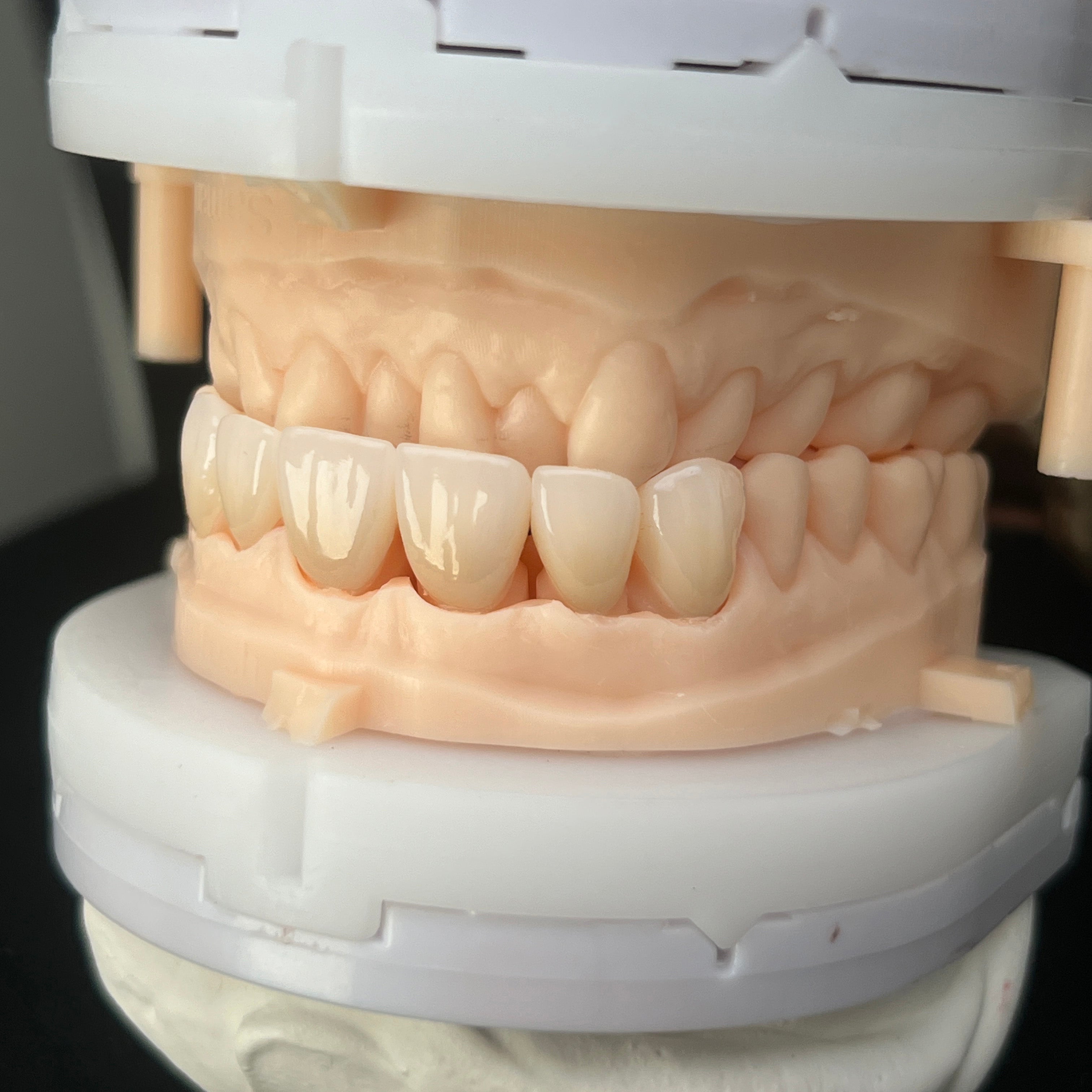 Multilayer Zirconia Dental Restorations