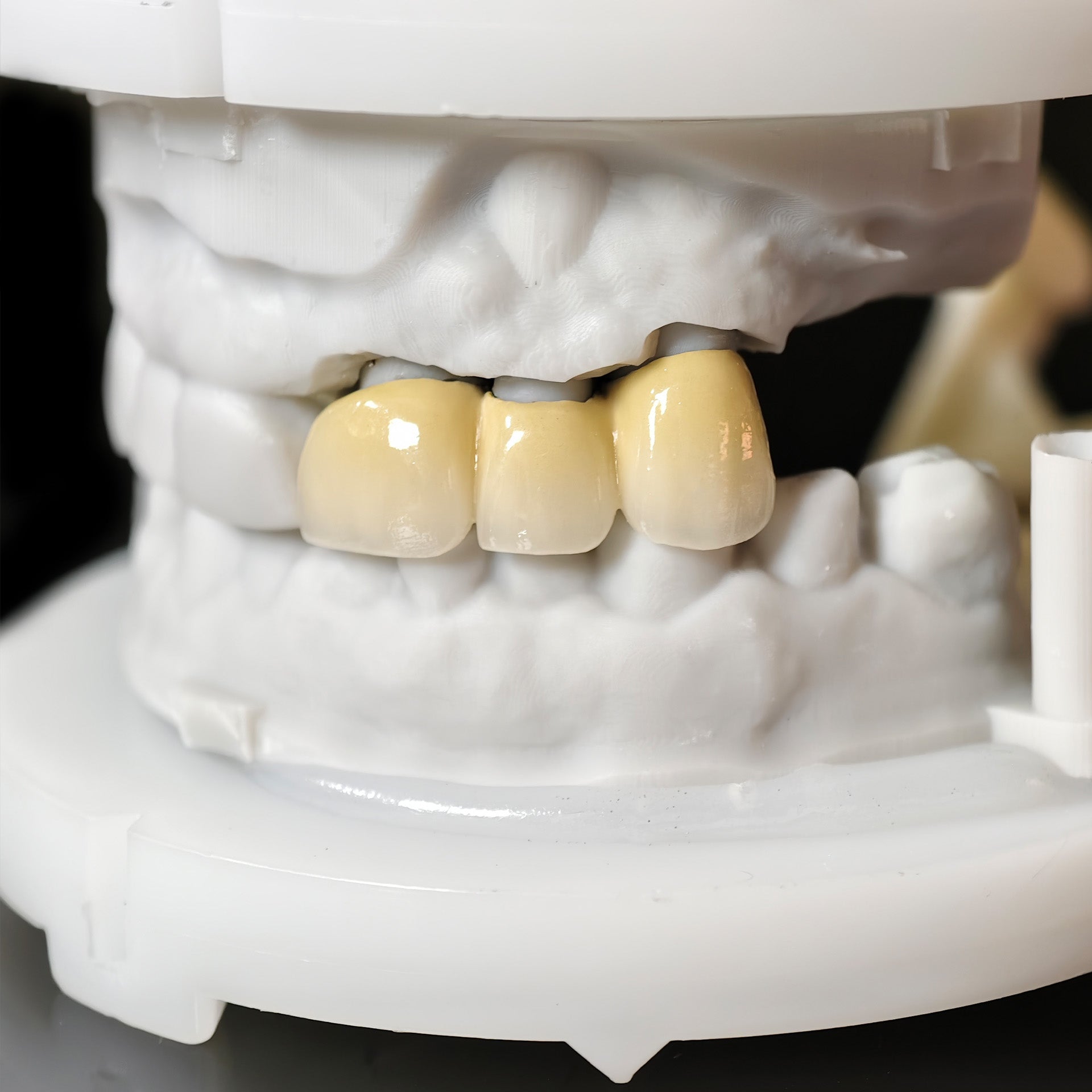 Co - Cr PFM Dental Bridge With Metal Post-And-Core