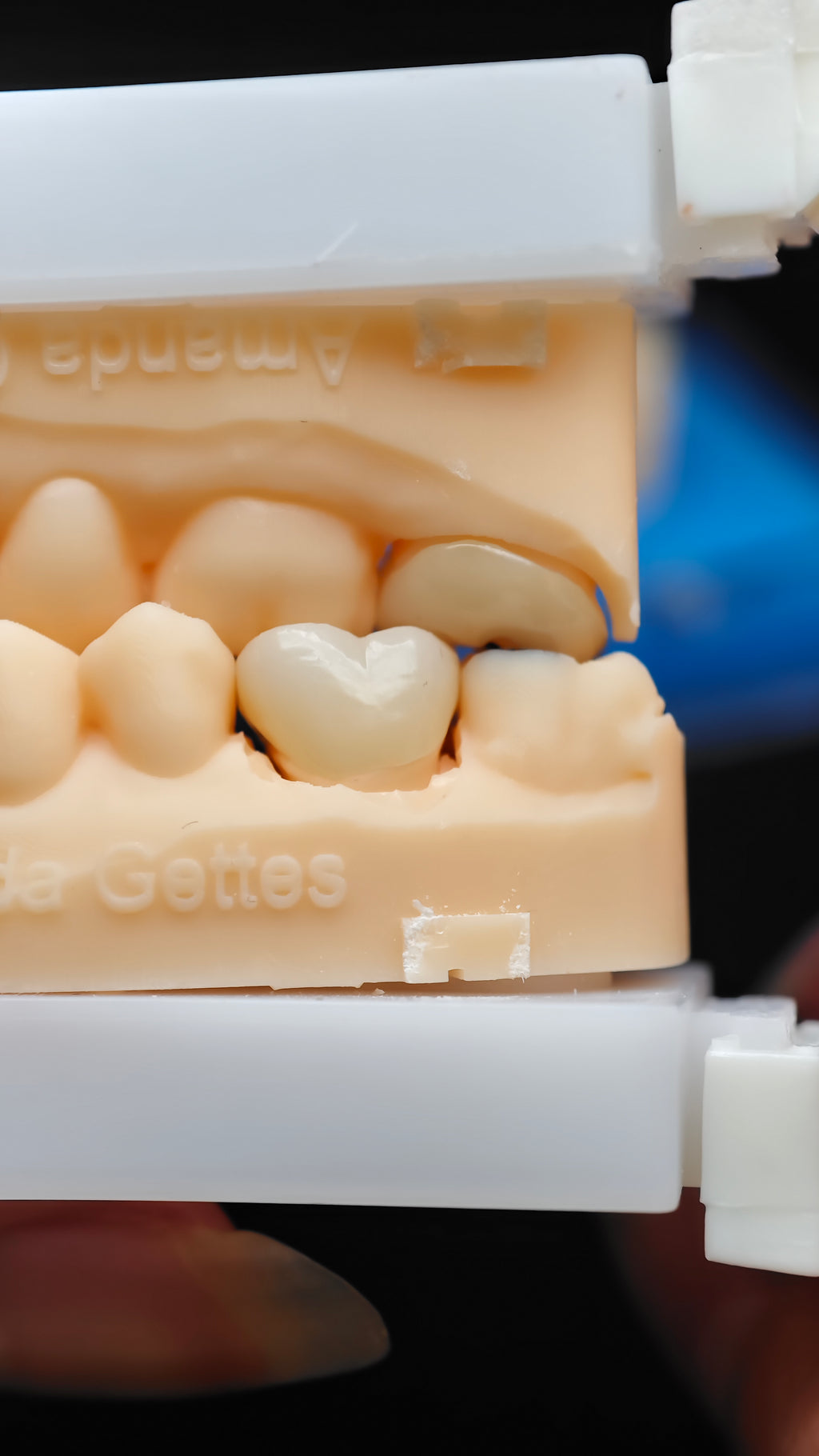 High - Strength Zirconia Dental Crowns