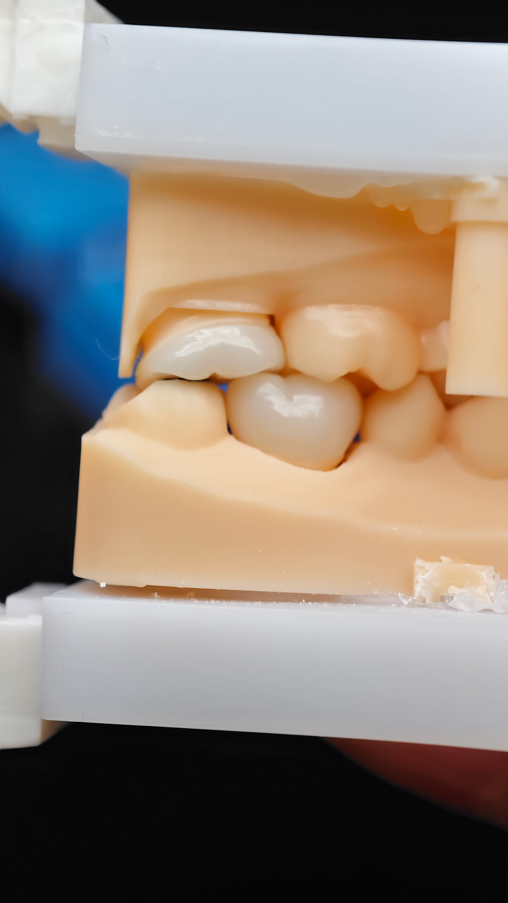 High - Strength Zirconia Dental Crowns