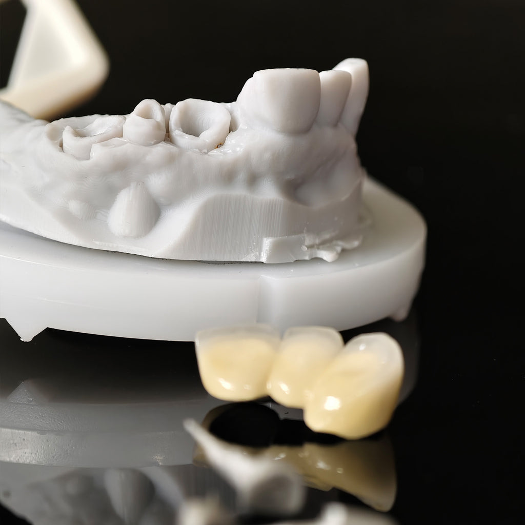 Co - Cr PFM Dental Bridge With Metal Post-And-Core