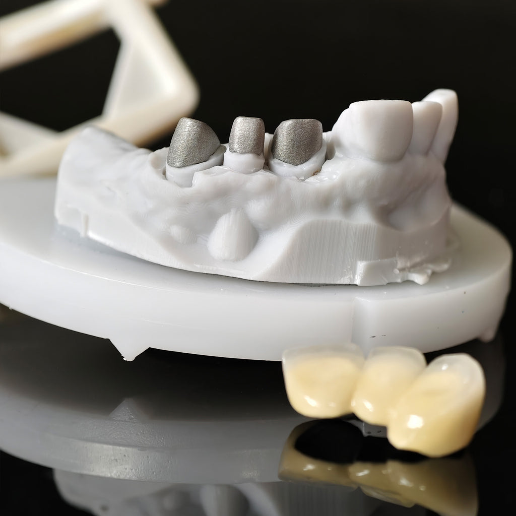 Co - Cr PFM Dental Bridge With Metal Post-And-Core